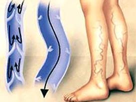 کاهش واریس در بارداری