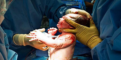 شرح کامل نحوه عمل سزارین C/Section 