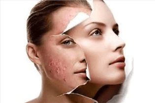 با گیاهان دارویی آکنه را از بین ببرید 