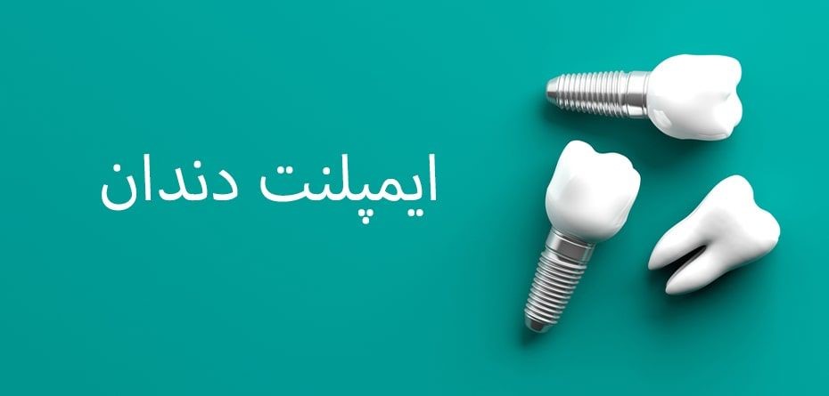 15 سوال رایج در مورد ایمپلنت 