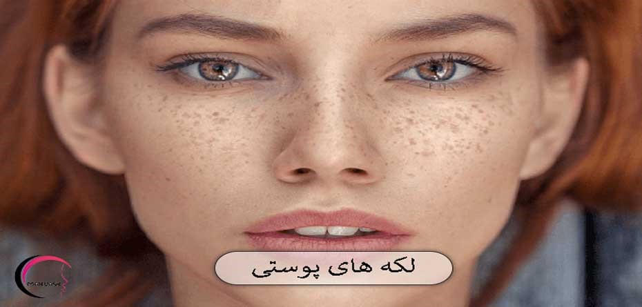 لکه های پوستی چگونه از بین می روند؟ راز زیبایی برای لکه های پوستی