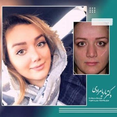 عمل بینی طبیعی با دکتر ماریا مرادی