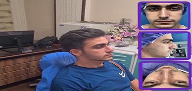 آشنایی با مدل های مختلف در جراحی بینی