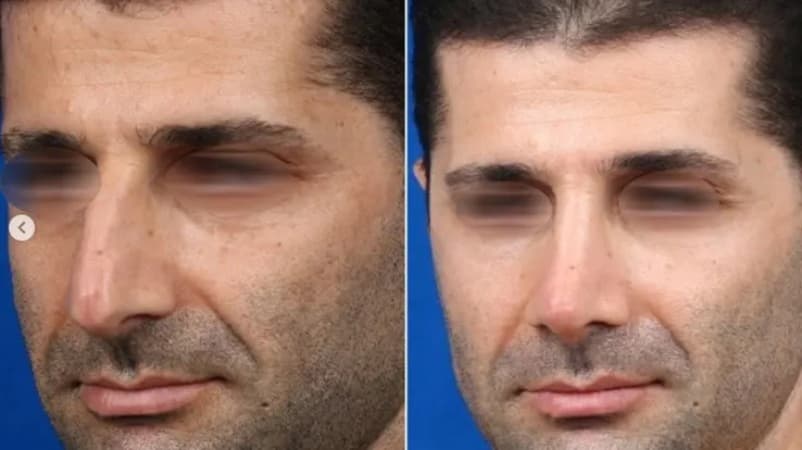 عمل بینی برای چه افرادی مناسب است؟