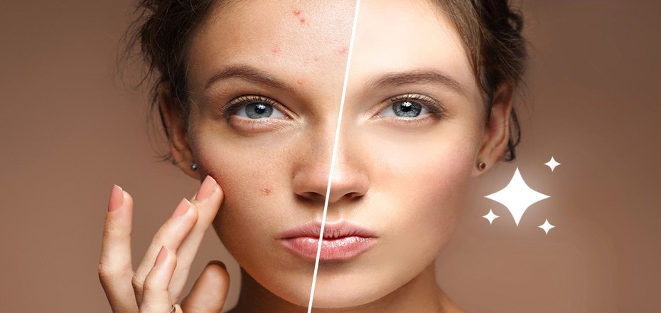 از بین بردن لک های صورت بدون عمل جراحی