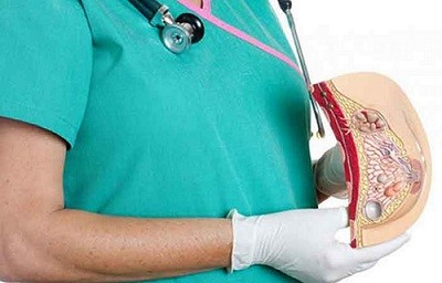  کیست سینه چیست و چگونه درمان می شود؟