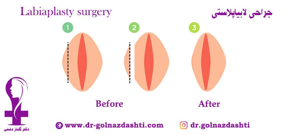 همه چیز راجب جراحی زیبایی واژن (لابیاپلاستی)