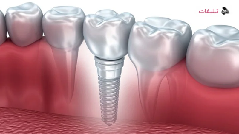 عوامل موثر بر قیمت ایمپلنت دندان