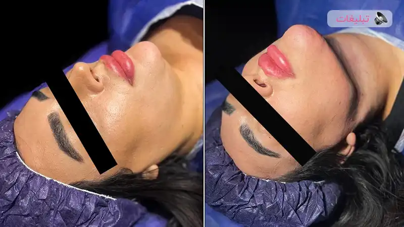 لیپوساکشن غبغب: روشی مؤثر برای زاویه سازی طبیعی صورت