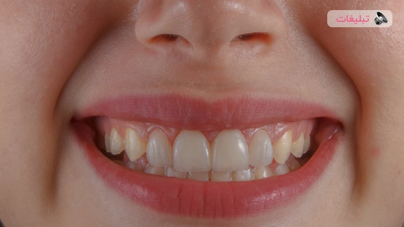 فرق لمینت با کامپوزیت دندان؛ لمینت بهتر است یا کامپوزیت دندان