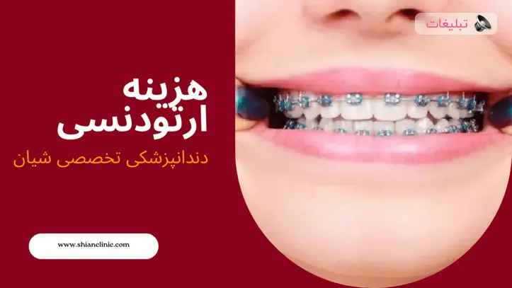 قیمت ارتودنسی چقدر است؟ هزینه ارتودنسی نی نی سایت