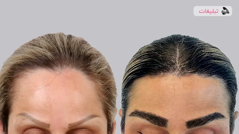 کاشت ابرو با جدیدترین متدهای روز دنیا