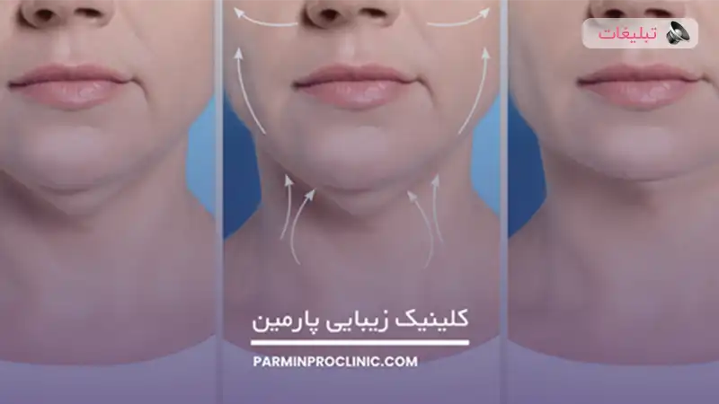 ساکشن غبغب بدون جراحی، سریع ترین راه برای از بین بردن غبغب | بررسی هزینه ساکشن غبغب تهران سال 1404