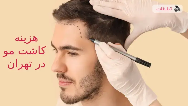 هزینه کاشت مو در بهترین کلینیک‌های تهران چقدر است؟ + بررسی کامل