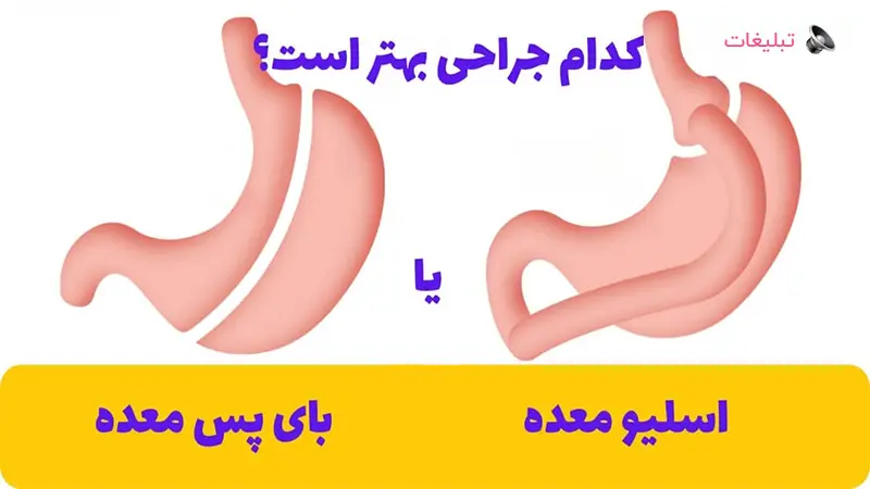 فراتر از کاهش وزن اسلیو معده یا بای پس معده در جهت بهبود کیفیت زندگی مادران پس از زایمان