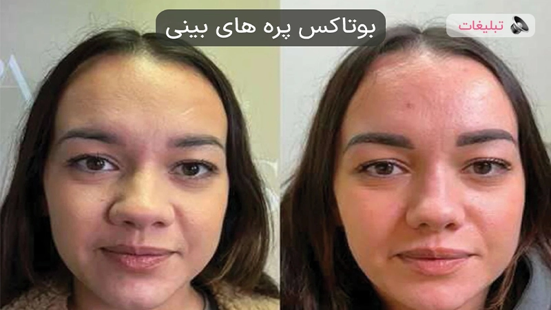 بوتاکس پره های بینی؛ بینی باریک تر بدون جراحی