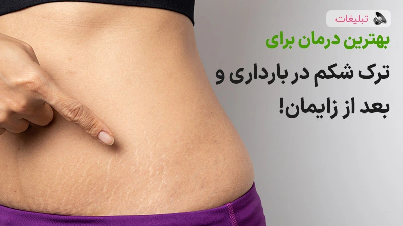بهترین درمان ترک شکم بعد از زایمان